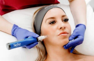 SkinPen Microneedling